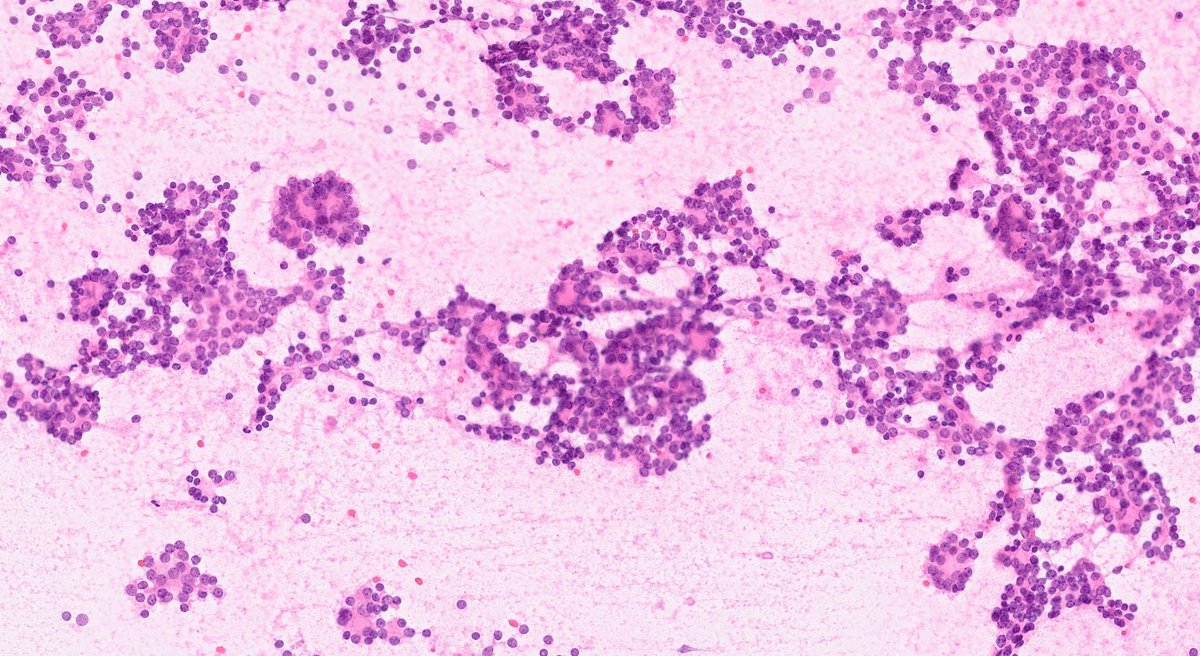 WillyFogPath's tweet image. Sabías que... los patólogos utilizan el Sistema Bethesda para el diagnóstico citológico por punción de lesiones de tiroides🦋
Nueva versión 2023.
🔹️I insuficiente
🔹️II benigno
🔹️III atípico
🔹️IV neoplasia folicular
🔹️V sospechoso
🔹️VI maligno
#CytoPath #EndoPath #PAAF