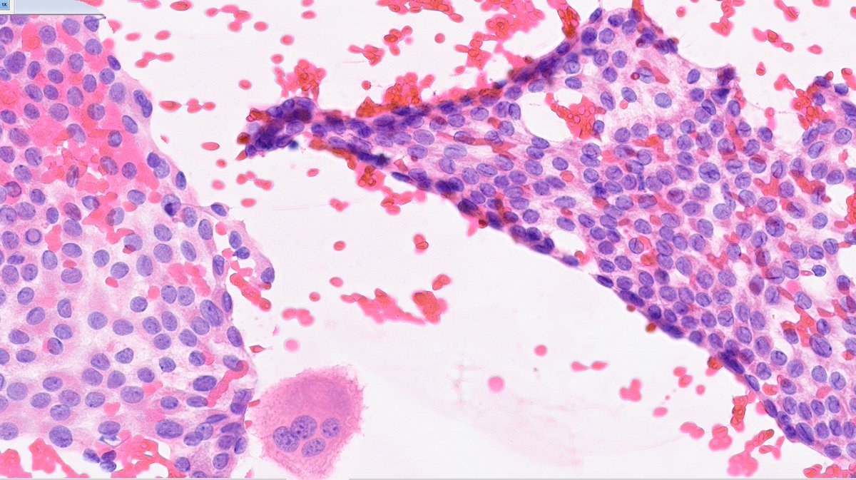 WillyFogPath's tweet image. Sabías que... los patólogos utilizan el Sistema Bethesda para el diagnóstico citológico por punción de lesiones de tiroides🦋
Nueva versión 2023.
🔹️I insuficiente
🔹️II benigno
🔹️III atípico
🔹️IV neoplasia folicular
🔹️V sospechoso
🔹️VI maligno
#CytoPath #EndoPath #PAAF