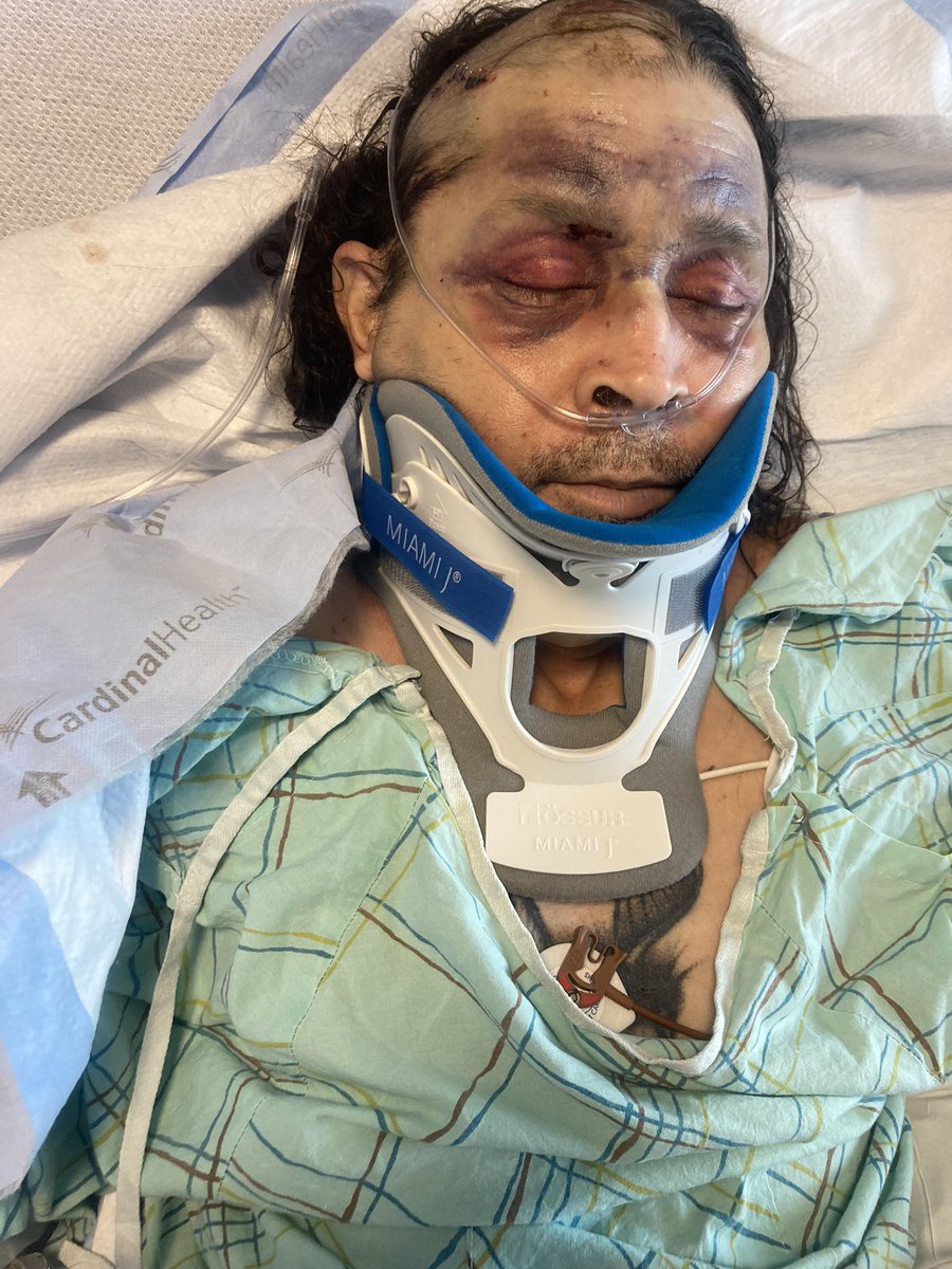 WHEC_JLewke's tweet photo. Frankie Hernandez was in the backseat of the car that went into the sink hole in Irondequoit earlier this week.  His family tells me he has head and spinal injuries.  He and his wife were delivering papers on Frankie’s route when the road gave out beneath them.@news10nbc https://t.co/xqwkePwV1d