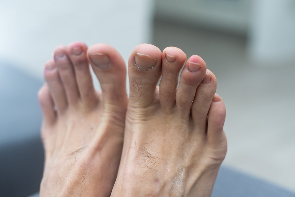 Keep your toenails trimmed and filed straight across to prevent toenail fungus from taking hold. Use clean, sterile nail clippers and avoid overly tight shoes that can put pressure on your nails. #NailCareTips #ToenailHealth bit.ly/34SCRen