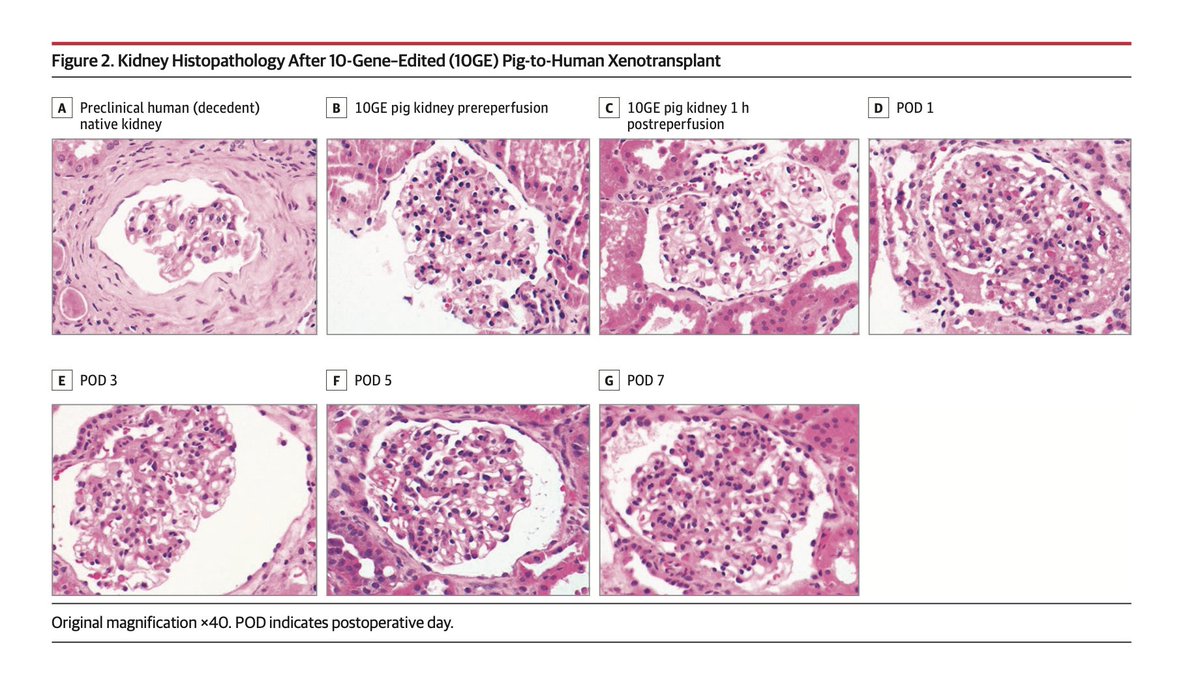 ssfarouk's tweet photo. Normal Graft Function After 🐷 -to-Human
#Kidney Xenotransplant @JAMASurgery 

Induction: eculizumab, ATG, rituximab, steroid
Maintenance: FK, MMF, pred 

37L urine/first 24 hrs
Cr 3.9 >> 1.1 at 48 hr 
Normal biopsies

@VineetaKumar8 @UAB_NRTC

https://t.co/F5npmj6vYv https://t.co/fZyF7t3zaa