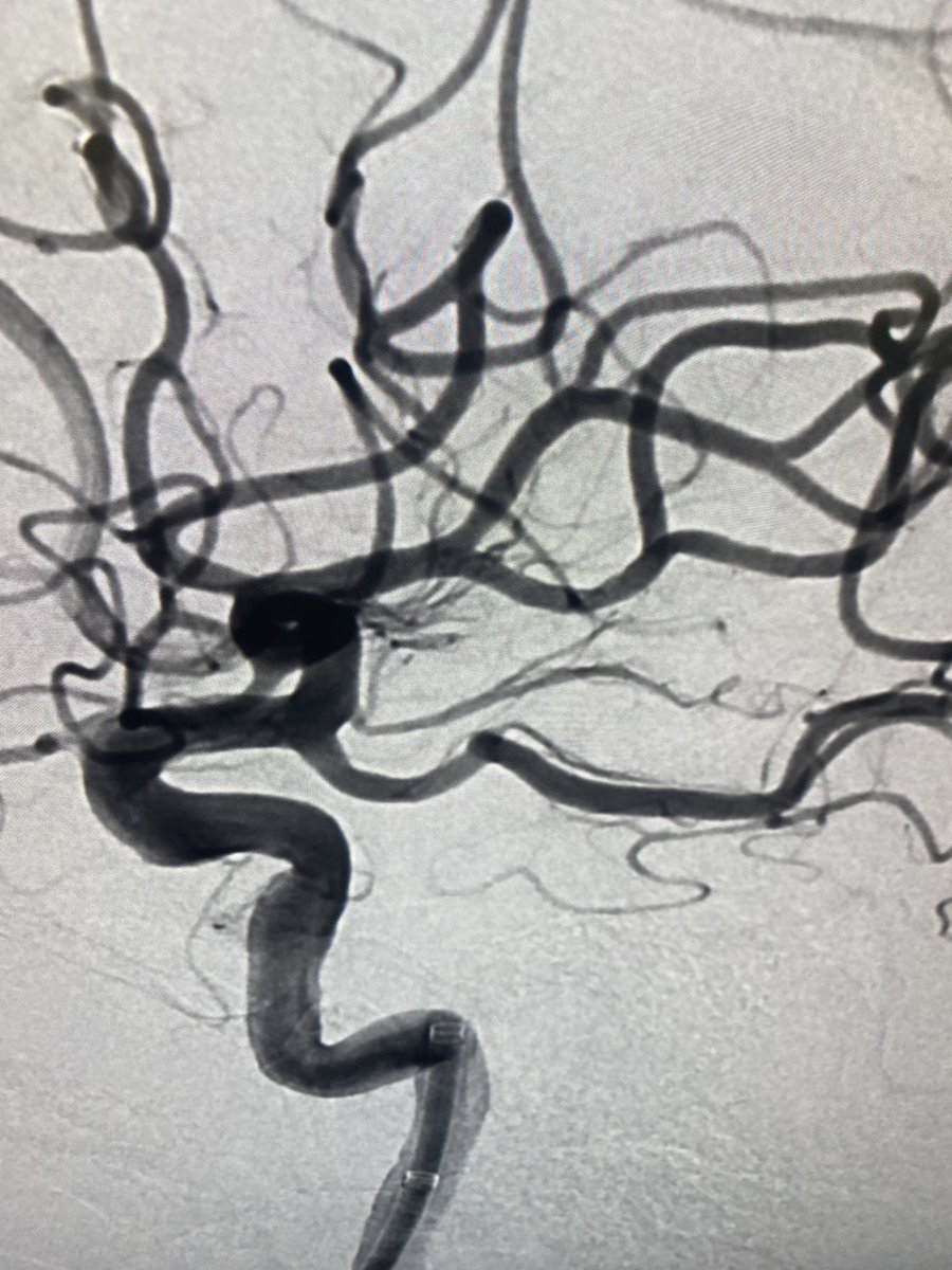 #Tiger17 for the win! TICI3 first pass. <a href="/Rapid__Medical/">Rapid Medical</a>