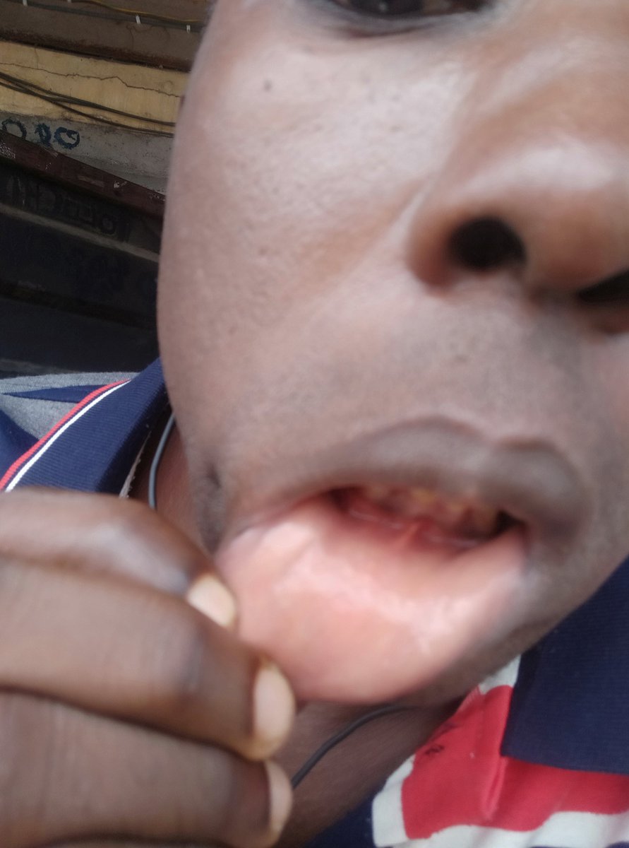 henryspace3's tweet image. #chucko #buger #peanuts #shes18 #Tinubu #jegabang #lawyer  this company want to finish my teeth with stone inside #peanut I need a #lawyer they are becoming careless