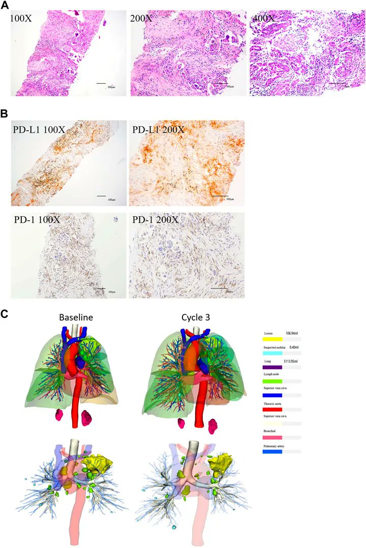 Case Report: Chemotherapy-free treatment with camrelizumab and anlotinib for elderly patients with KRAS and TP53 mutated advanced lung cancer 
buff.ly/3YdLyWB