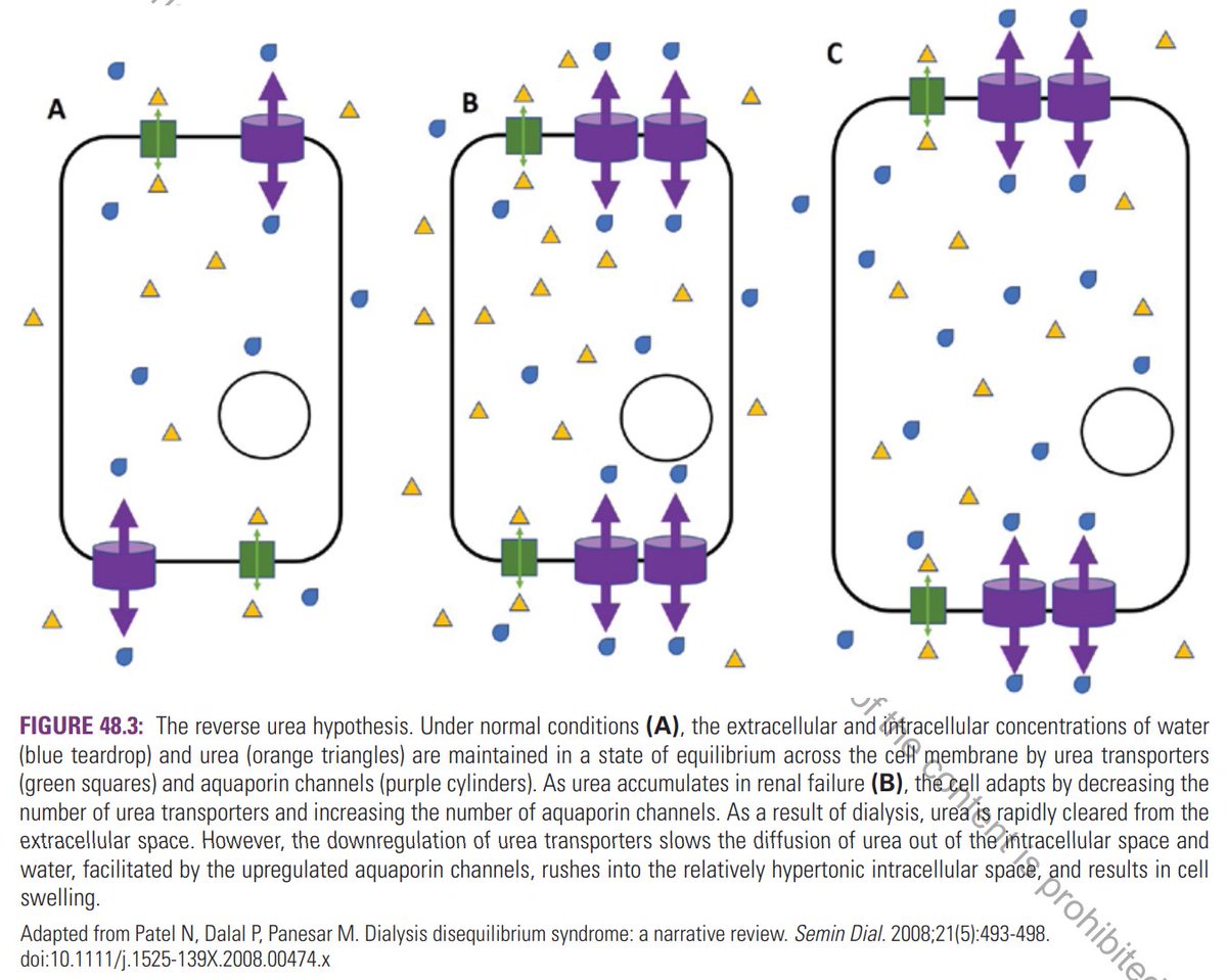 edgarvlermamd's tweet photo. Dialysis Dysequilibrium Syndrome #Nephpearls #PathophysiologyPearls 

According to the "reverse urea hypothesis," urea is unable to move freely between the extra- and intracellular spaces in neuronal tissue because of the presence of tight junctions and other components of the blood-brain barrier (BBB).

When urea is rapidly removed from the plasma water during intermittent dialysis, urea molecules are slow to move out of cells, including neurons, and CSF which results in a temporary increase in intracellular urea concentration relative to plasma (it can take up to 12-24 hours for the urea in the brain to equilibrate with blood).

Given that the water movement through aquaporins is about 20 times faster than urea transport, water will move along the concentration gradient generated by the difference in urea concentration, passing into the brain and leading to the development of brain swelling and eventual increase in the intracranial pressure (ICP).

https://t.co/F1MzoMXO2c