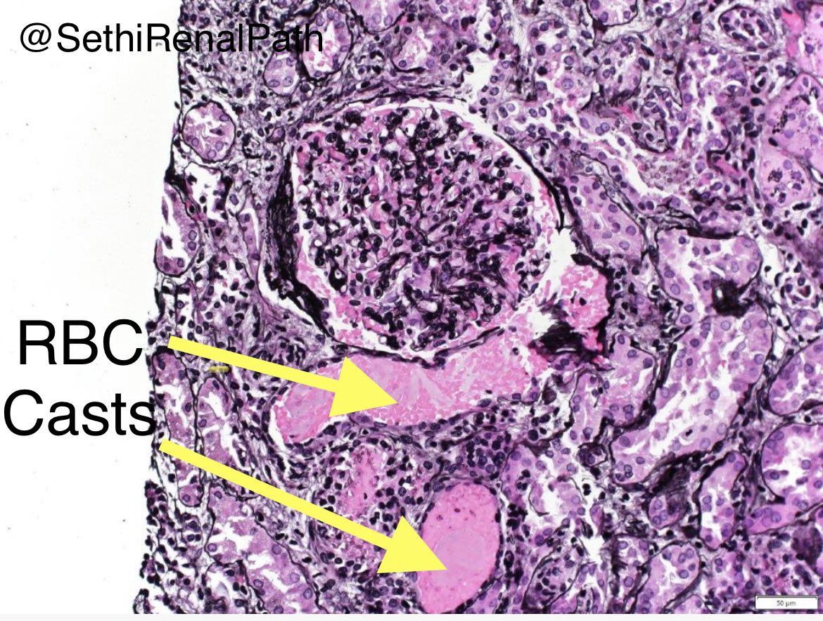 SethiRenalPath's tweet photo. A simple case but I’m always baffled by this finding-
Normal appearing glomerulus with RBCs leaking through &amp; forming RBC casts.

Urine: RBC and RBC casts.

Dx: IgA nephropathy with mild mesangial proliferative features.

Oxford-M1 E0 S0 T0 C0

23 yr old, hematuria &amp; proteinuria https://t.co/OWJ2prlvEW
