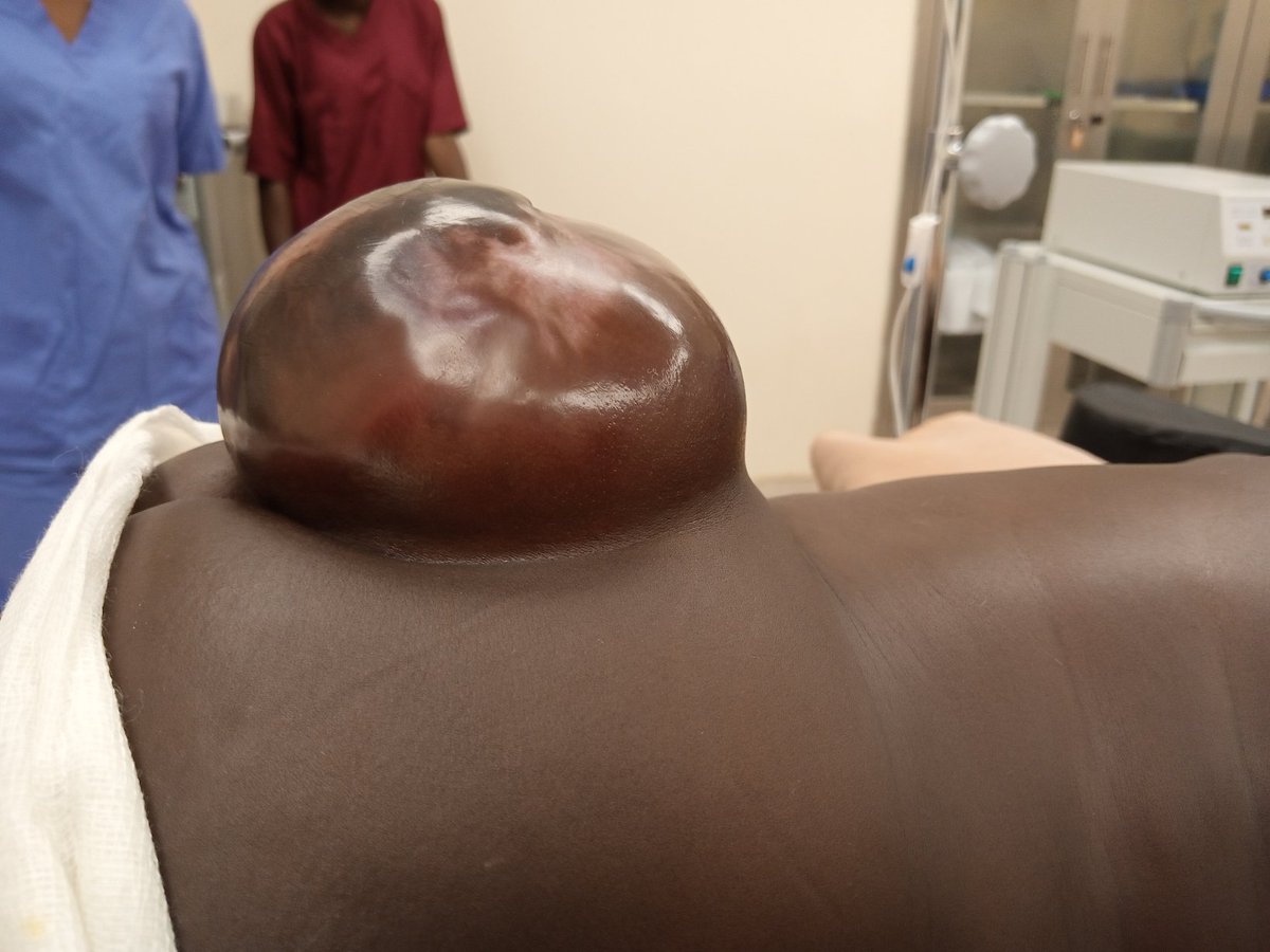 TamayoHorta's tweet photo. Last case in #Maradi #Niger: Px F, 5 months old, with mild femoral paresis, signs of epithelialization of the #placode. 

#Neurosurgery https://t.co/5uC4edaiEV