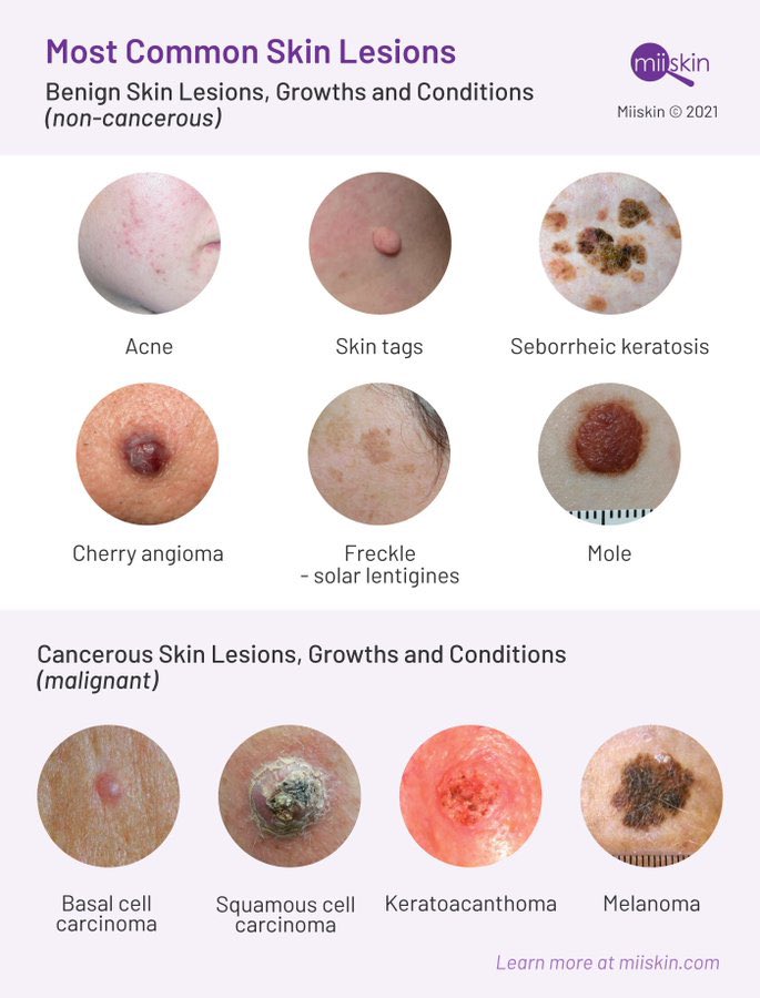 Most common skin lesions Credit: @miiskinapp
#MedEd #FOAMed #Dermtwitter #Medtwitter #Medstudenttwitter