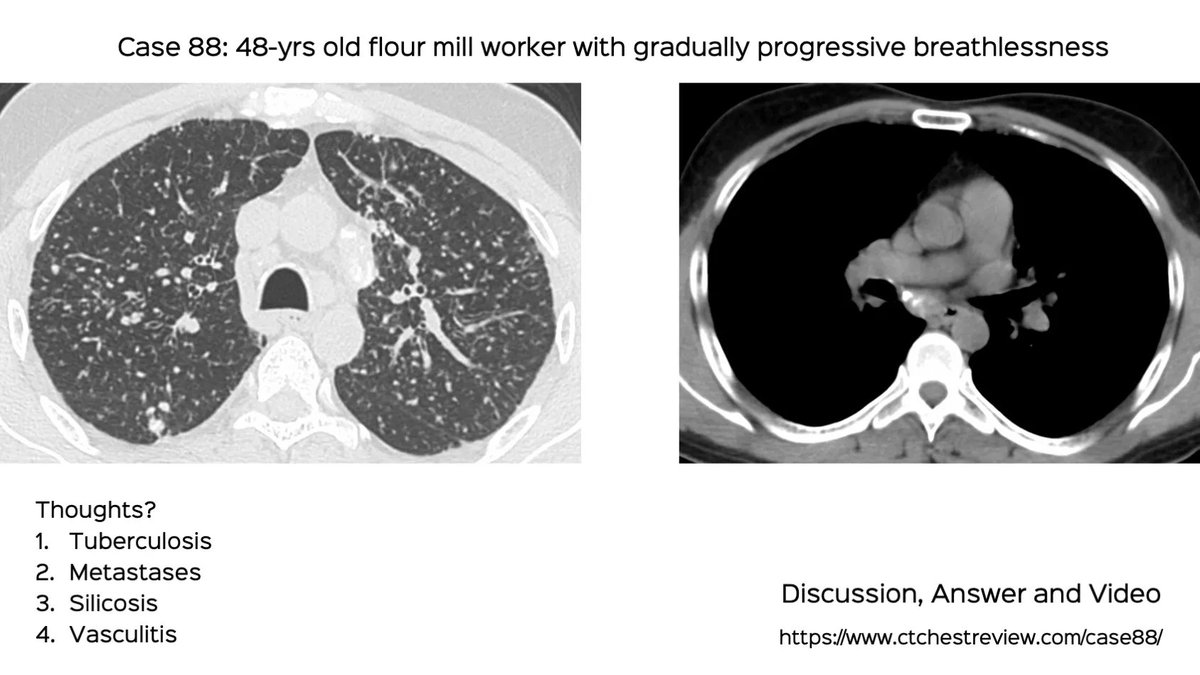 Case 88: Flour Mill Worker Disease

48-yrs old with gradually progressive dyspnea.

Thought?

ctchestreview.com/case88/

#chestrad #ctchest #FOAMrad #radres #ILDs #flourmill