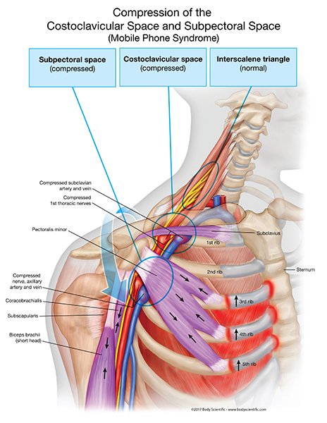 OBandarchi's tweet photo. TOS has many causes &amp; one of them is POOR POSTURE .The most common poor posture seen with TOS involves standing with rounded shoulders &amp; forward head. TEXT NECK IS A GLOBAL EPIDEMIC! And a world-wide health concern,affecting millions of all ages &amp; from all walks of life. https://t.co/s0MtVEuZhf