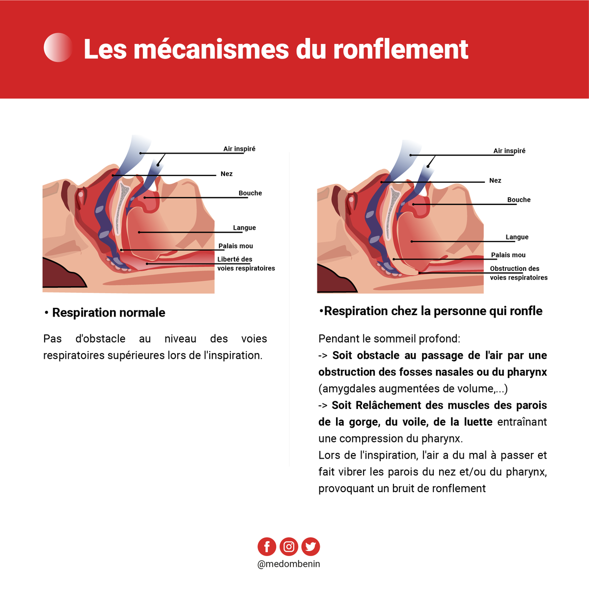 BeninMedom's tweet photo. Les ronflements (Partie 1) 
Votre conjoint.e se plaint du fait que vous ronflez chaque fois que vous dormez ? 

Votre enfant ronfle toujours au cours de son sommeil ? 

Ce n'est pas normal !! 

Qu'est ce que le ronflement? Quels en sont les mécanismes et les conséquences? https://t.co/NGF9RPKFnh