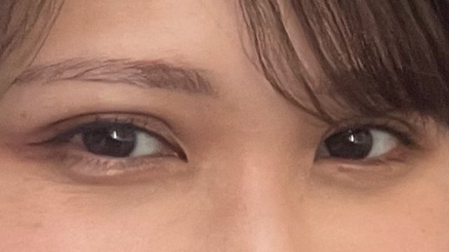 futaediary's tweet photo. 田中　咲さん(30)の埋没正直レポ👀

🏥クリニック：Lorクリニック　表参道店
👨‍⚕️執刀医：秋葉先生
✏️メニュー名：二オーダーメイド二重
💰料金：198,000円

ダウンタイム★★★★★
ダウンタイム2日目↓
....
ダウンタイム3日目↓
....痛みはなかった。
術後は1ヶ月ほど違和感があったが、私が感じていただけのようで、周囲にはバレなかった。

カウンセリング★★★★★
執刀医が親身に何度もシュミレーションをしてくれた。看護師も丁寧な対応だった。待ち時間が少し長かった。
before↓
....
執刀医の技術★★★★★
態度・対応★★★★★
親身に何度もシュミレーションをしてくれた。
優しくなんでも聞きやすい雰囲気で非常に良い先生だと感じた。
after↓
....
みんなにアドバイス！:
SNSなどで医師のキャラクターや、症例の写真、クリニックの口コミを確認するのをお勧めします。

さらに詳しいレポはプロフリンクから✨
クリニックや執刀医ごとにレポを探せます📝
悪い口コミ、瞬きをしている動画も公開しています◎