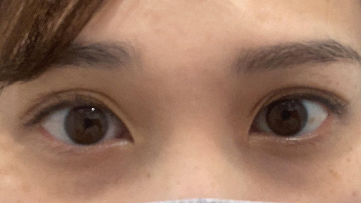 futaediary's tweet photo. 田中　咲さん(30)の埋没正直レポ👀

🏥クリニック：Lorクリニック　表参道店
👨‍⚕️執刀医：秋葉先生
✏️メニュー名：二オーダーメイド二重
💰料金：198,000円

ダウンタイム★★★★★
ダウンタイム2日目↓
....
ダウンタイム3日目↓
....痛みはなかった。
術後は1ヶ月ほど違和感があったが、私が感じていただけのようで、周囲にはバレなかった。

カウンセリング★★★★★
執刀医が親身に何度もシュミレーションをしてくれた。看護師も丁寧な対応だった。待ち時間が少し長かった。
before↓
....
執刀医の技術★★★★★
態度・対応★★★★★
親身に何度もシュミレーションをしてくれた。
優しくなんでも聞きやすい雰囲気で非常に良い先生だと感じた。
after↓
....
みんなにアドバイス！:
SNSなどで医師のキャラクターや、症例の写真、クリニックの口コミを確認するのをお勧めします。

さらに詳しいレポはプロフリンクから✨
クリニックや執刀医ごとにレポを探せます📝
悪い口コミ、瞬きをしている動画も公開しています◎