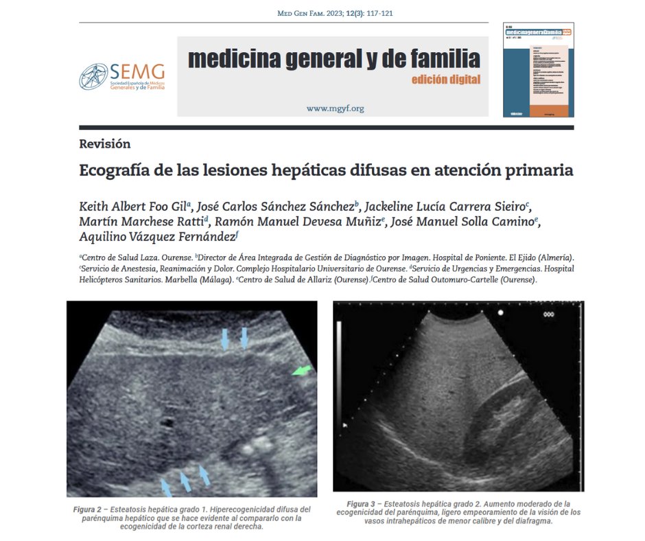La ecografía hepática se considera por su inocuidad, bajo coste, accesibilidad y rendimiento diagnóstico, la técnica de imagen de primera línea en la valoración inicial de los pacientes con sospecha o evidencia de enfermedad hepática y seguimiento
📖#RMGyF mgyf.org/ecografia-de-l…