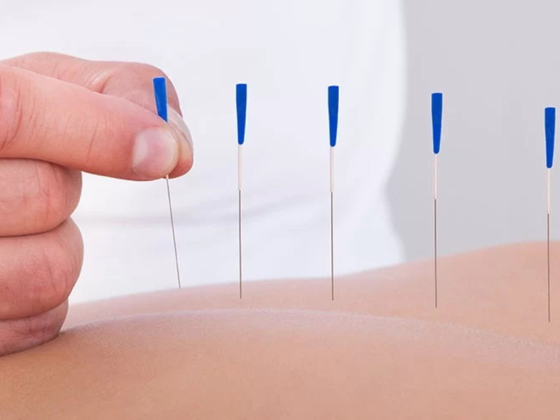 LivingTraverse's tweet photo. Benefits of Dry Needling at ONE PT https://t.co/vhukLXe8Dz 

#physicaltherapy #dryneedling #health #therapy #traversecity #michigan https://t.co/EIYzx3ogW7