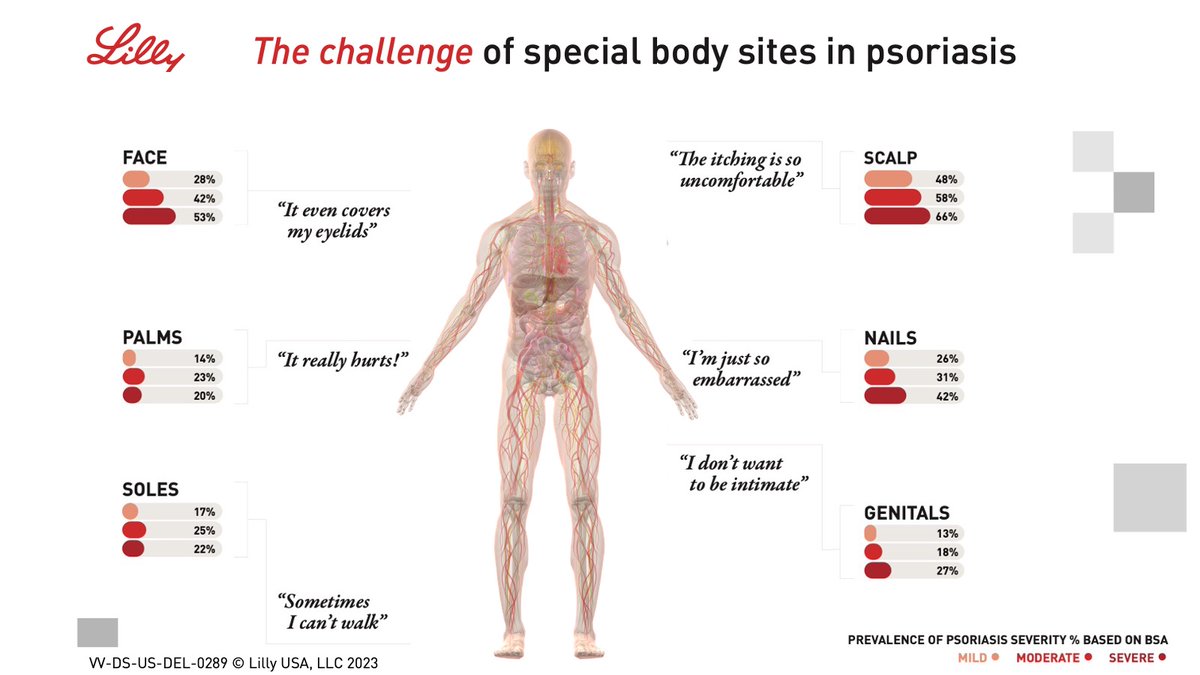 LillyMedical's tweet photo. Psoriasis varies in its impact on patients. Patients will have differing perceptions, and when compared to physicians, they may prefer certain treatment attributes over others. In #PsoriasisActionMonth, reflect on patient treatment goals. Learn more here: https://t.co/sqbkifut8f https://t.co/rhVHyuBARo