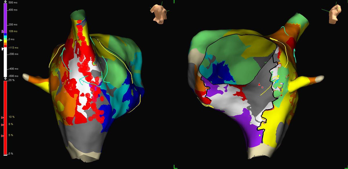 Mert İlker Hayıroğlu (@mertilkerh) on Twitter photo 40y, F , operated for VSD, incessant SVT with variable cycles ,Cp is early, entrainment from prox is shorter, CTI made cycle stable. A line from IVC to SVC with diaphragm check restored NSR. Ef 25%, RA 60x55 mm #Epeeps #CardioTwitter great maps from <a href="/NurigunayEP/">Nuri Günay</a> 40y, F , operated for VSD, incessant SVT with variable cycles ,Cp is early, entrainment from prox is shorter, CTI made cycle stable. A line from IVC to SVC with diaphragm check restored NSR. Ef 25%, RA 60x55 mm #Epeeps #CardioTwitter great maps from <a href="/NurigunayEP/">Nuri Günay</a>