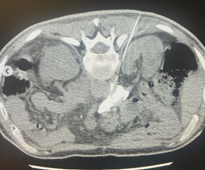 fcpiskin's tweet photo. Celiac trunk blockage was done successfully by percutaneous approach due to resistant pancreatic cancer pain. 
@cirsesociety @The_IASIOS @ECIOcongress @tugsanb
#interventionalradiology #interventionaloncology https://t.co/IQSjnoHDMk