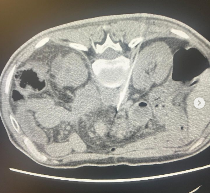 fcpiskin's tweet photo. Celiac trunk blockage was done successfully by percutaneous approach due to resistant pancreatic cancer pain. 
@cirsesociety @The_IASIOS @ECIOcongress @tugsanb
#interventionalradiology #interventionaloncology https://t.co/IQSjnoHDMk