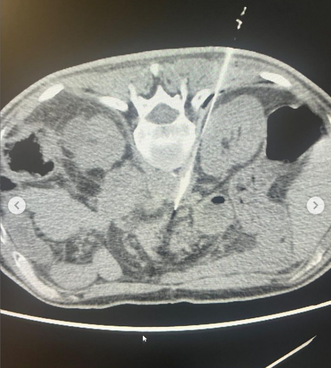 fcpiskin's tweet photo. Celiac trunk blockage was done successfully by percutaneous approach due to resistant pancreatic cancer pain. 
@cirsesociety @The_IASIOS @ECIOcongress @tugsanb
#interventionalradiology #interventionaloncology https://t.co/IQSjnoHDMk