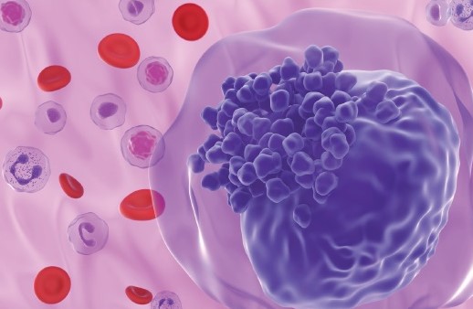 OncologyTimes's tweet photo. Researchers developed a method to distinguish between cancerous and healthy #stemcells and progenitor cells in acute myeloid #leukemia. The researchers used single-cell RNA sequencing and then applied #CloneTracer to the data. https://t.co/i1qyCezrdb https://t.co/uAoGIWGXVA