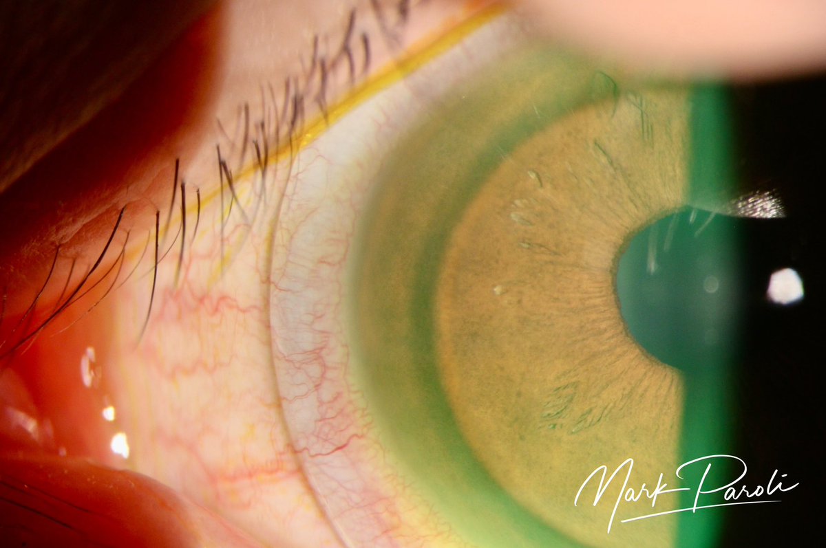 its_MarkParoli's tweet photo. Scleral Lens fitting of a Cornea with Keratoconus s/p Corneal Crosslinking. 200 microns near the apex of the Keratoconus. #scleral #sclerallens #keratoconus #crosslink #optometry #ophthalmology #cornea #contactlens https://t.co/ftZiJpir5D
