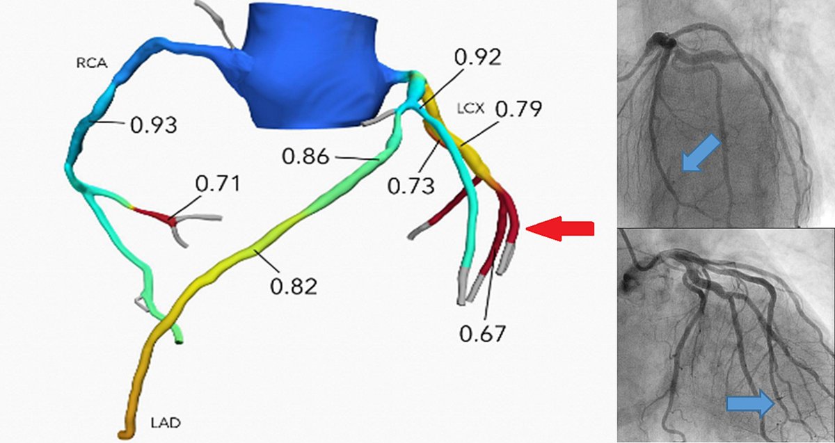 Just accepted in <a href="/CRMjournal/">CRMjournal</a>+@ELS_Cardiology!

#CTFFR discrepancies with invasive angiography and physiology by Ilan Merdler, <a href="/DorBen/">Itsik Ben Dor</a>, <a href="/hect2701/">Prof. Hector M. Garcia-Garcia</a>, <a href="/RyanKabirMD/">Ryan Kabir, MD</a>, <a href="/gabyweissman/">Gaby Weissman</a>, <a href="/BhogalSukhdeep/">Sukhdeep Bhogal</a>, <a href="/ron_waksman/">Ron Waksman</a> et al.

clinicalkey.com/#!/content/pla…