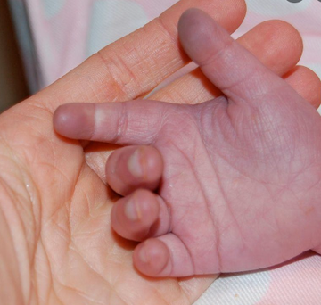 recentadvances's tweet photo. What is a Blue Baby?    
This term is employed for #babies who develop bluish discoloration of body as well as the mucus membrane. This change in the body color is technically called "Cyanosis". 

Read further 
https://t.co/MIOJmEwR8v

#Pediatrics #healthcare #health #child https://t.co/p6cuuWOO9P