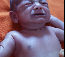 recentadvances's tweet photo. What is a Blue Baby?    
This term is employed for #babies who develop bluish discoloration of body as well as the mucus membrane. This change in the body color is technically called "Cyanosis". 

Read further 
https://t.co/MIOJmEwR8v

#Pediatrics #healthcare #health #child https://t.co/p6cuuWOO9P