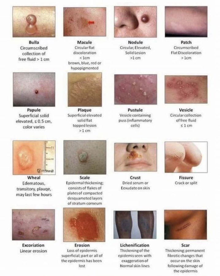 Different types of skin lesions
#skin #meded #InnoMed
#MedTwitter h/t @NicoGagelmann