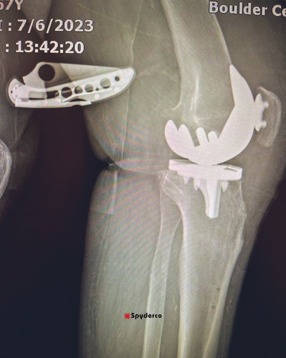 SpydercoKnives's tweet image. How do you know when a loyal Spyderco user has had a knee replacement? Just check the post-op X-rays.

#SpydercoKnives