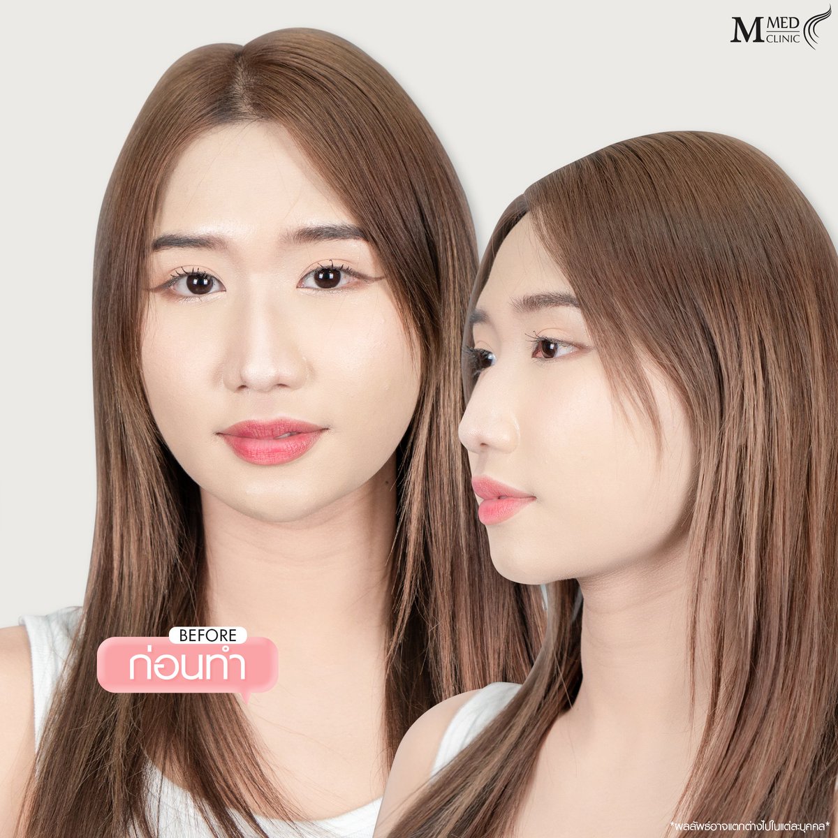 ClinicMmed's tweet photo. ไม่ถนัดใช้   filter ถนัดเติมFiller มากกว่า
🎉 L!ne : @mmedclinic ( มี@ข้างหน้าด้วยนะคะ) หรือคลิก https://t.co/7JqdBMkKg8 📷จองคิวปรึกษาฟรี
#mmedclinic #เอ็มเมดคลินิค #รีวิวเอ็มเมด #ฉีดผิว #โปรดีบอกต่อ #Botox #filler #ฟิลเลอร์ #วิตามินผิว #ตาสองชั้น #ตัดหนังตาใต้คิ้ว #subbrowlift https://t.co/yXNtWAMzTK
