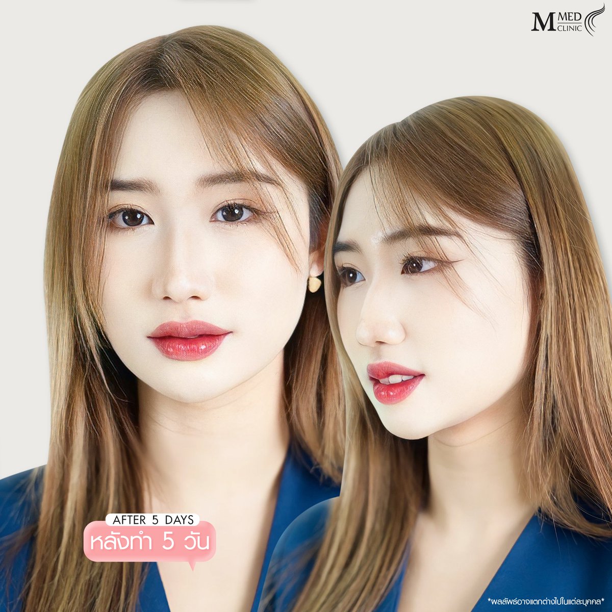 ClinicMmed's tweet photo. ไม่ถนัดใช้   filter ถนัดเติมFiller มากกว่า
🎉 L!ne : @mmedclinic ( มี@ข้างหน้าด้วยนะคะ) หรือคลิก https://t.co/7JqdBMkKg8 📷จองคิวปรึกษาฟรี
#mmedclinic #เอ็มเมดคลินิค #รีวิวเอ็มเมด #ฉีดผิว #โปรดีบอกต่อ #Botox #filler #ฟิลเลอร์ #วิตามินผิว #ตาสองชั้น #ตัดหนังตาใต้คิ้ว #subbrowlift https://t.co/yXNtWAMzTK