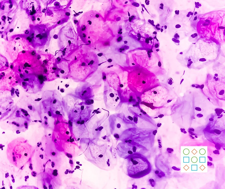 PET_BioNews's tweet photo. The family of Henrietta Lacks has reached a settlement with the biotechnology company that profited from her #cervicalcancer cells without her consent. 
Georgia Canton writes about this for BioNews: https://t.co/xiWccGdRc3

#HeLa #HeLacells #bioethics #cancer #CancerResearch https://t.co/muT4NxvZZ5