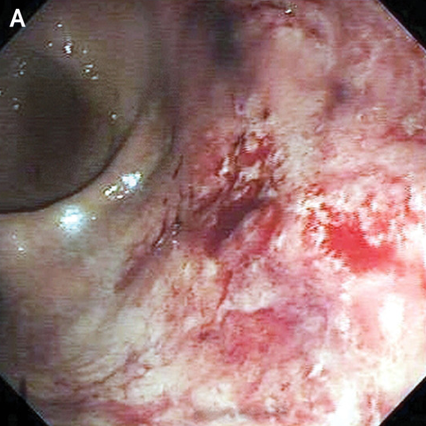 guerreroespejo's tweet photo. A 50-YO ♂️, 2 month before #condomless receptive #anal intercourse with a new partner: a 1-month of painful hematochezia.

Colonoscopy: an ulcer in the distal rectum with bleeding (A).
1/3

DOI: 10.1056/NEJMicm2301469
#sexually #gastroenterology https://t.co/9roNj307G1