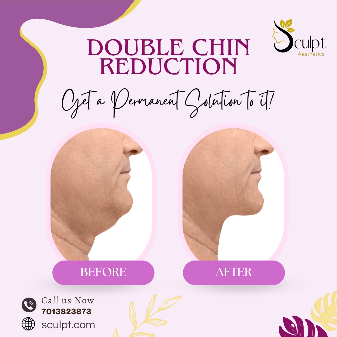 'Chasing that Chiseled Jawline: Tips for Double Chin Reduction'
#ChinContouring
#FacialSculpting
#ChinLift
#EnhanceYourProfile
#JawlineJourney
#ChinSculpt
#ChinReductionTechniques
#ChinElevation
#BeautifulProfile

call/whatsapp:7013823873