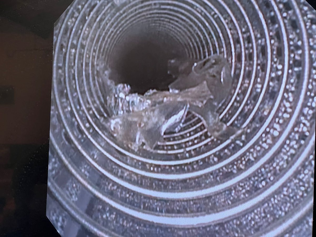 igna181212's tweet photo. Extracción de cuerpo extraño del interior de tubo traqueal. Impresiona de restos desprendidos de la pared interna del tubo. Se trataba de paciente obeso intervenido de absceso mandibular y la idea era cambiar tubo mediante intercambiador, previa retirada del material extraño. https://t.co/Su5OvEN2vv
