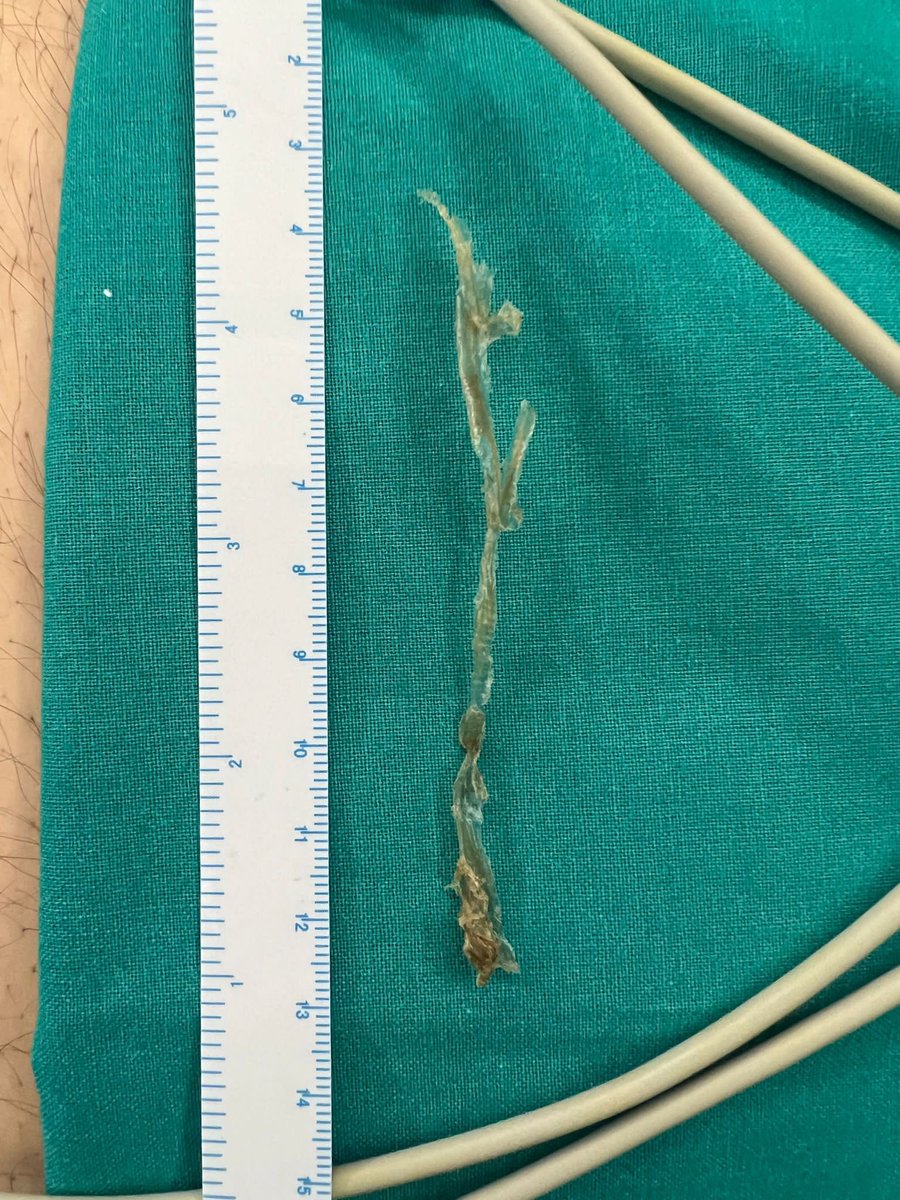 igna181212's tweet photo. Extracción de cuerpo extraño del interior de tubo traqueal. Impresiona de restos desprendidos de la pared interna del tubo. Se trataba de paciente obeso intervenido de absceso mandibular y la idea era cambiar tubo mediante intercambiador, previa retirada del material extraño. https://t.co/Su5OvEN2vv