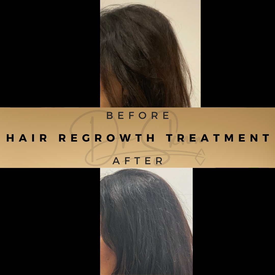 'Experience the Power of Nature & Science | Hair Loss Treatments at Dr Sknn Wilmslow Aesthetics Clinic'

#hairlosstreatment #hairlosshelp #altrincham #cheadlehulme #crewe #didsbury #scalptreatment #hairgrowth #hairgrowthproducts #hairregrowth