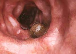 immunooncol's tweet photo. #Colorectalcancer is a growth of cells that forms in the lower end of the digestive tract. Most of these cancers start as non-#cancerous growths called polyps. https://t.co/CZ11PRiaqu