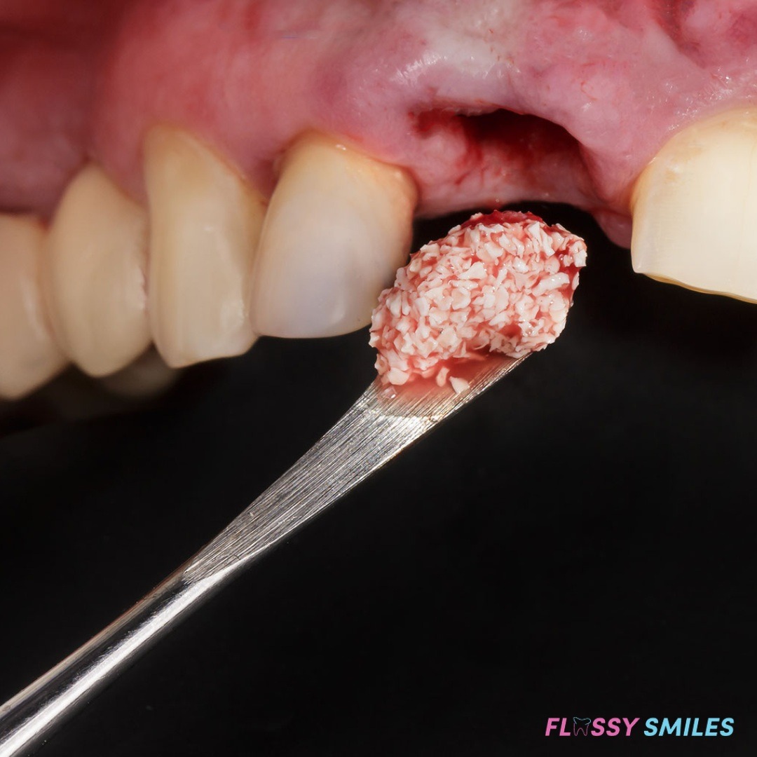 Our patient came in with pain due to a peri-apical infection. Tooth was immediately removed and a #bonegraft was placed in order to restore with a new #dentalimplant in 3-4 months of healing

#dentalimplants #bonegraft #missingtooth