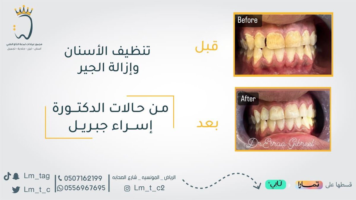 lam3ataltaj's tweet photo. مجمع عيادات لمعة التاج الطبي 
#للاستفسار_0556967695- 0507162199📞
انتم معانا دائماً الأجمل و الافضل🪞✨
اوقات العمل ⏰
 :من السبت الى الخميس من الساعه 9:00 حتى11:00  مساء 
الجمعه : من 3:00 مساء وحتى 11:00 مساء https://t.co/3KPK2WZ9iq