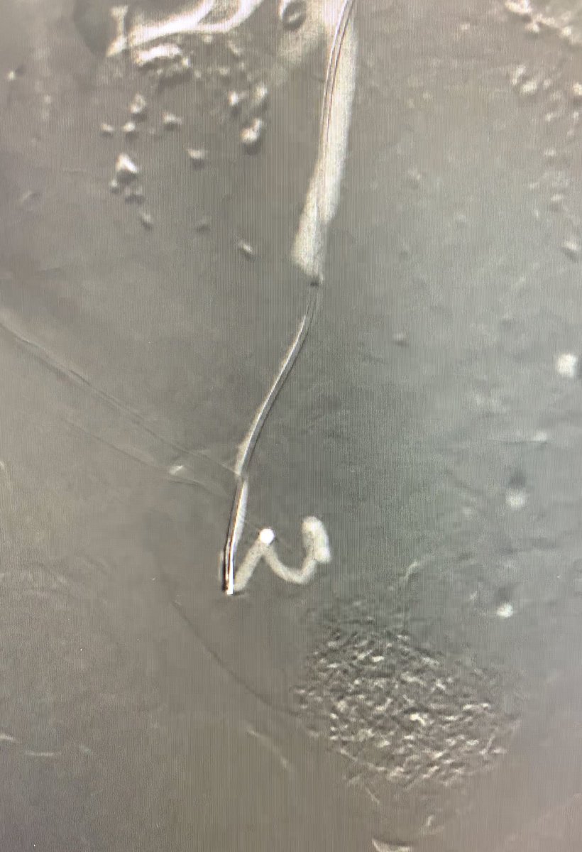 banderaldhafery's tweet photo. Menorrhoagia with renal impairment , #co2 guided #uterine artery embolization through #radial approach,,
Nothing can preclude patient from getting #UAE
#angiodroid
#uterine
#intervention
#IR https://t.co/6oBMafSceO