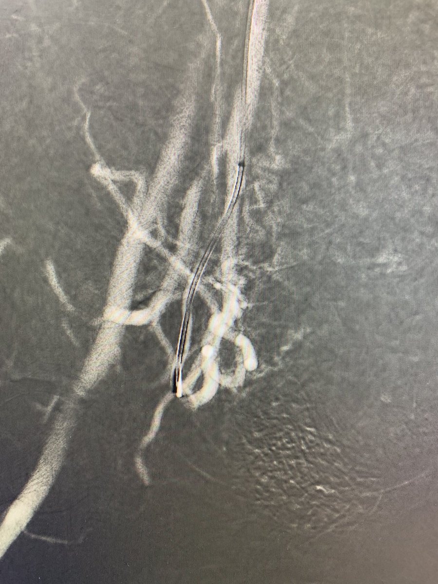banderaldhafery's tweet photo. Menorrhoagia with renal impairment , #co2 guided #uterine artery embolization through #radial approach,,
Nothing can preclude patient from getting #UAE
#angiodroid
#uterine
#intervention
#IR https://t.co/6oBMafSceO