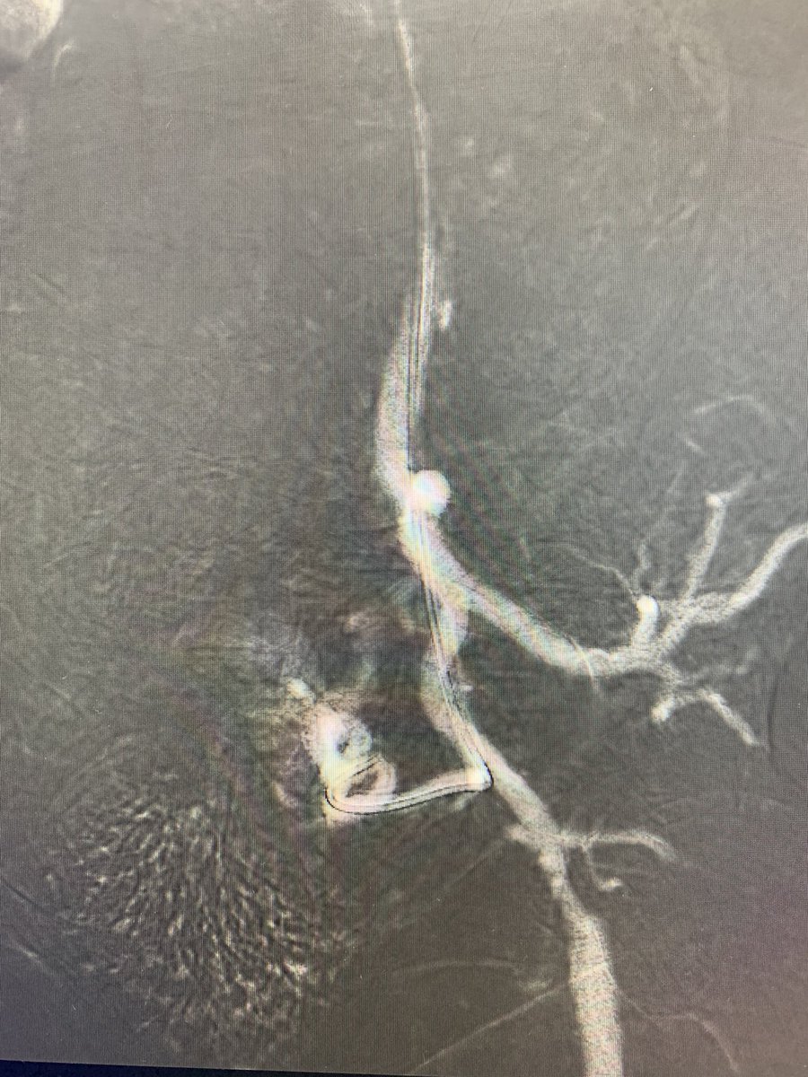 banderaldhafery's tweet photo. Menorrhoagia with renal impairment , #co2 guided #uterine artery embolization through #radial approach,,
Nothing can preclude patient from getting #UAE
#angiodroid
#uterine
#intervention
#IR https://t.co/6oBMafSceO
