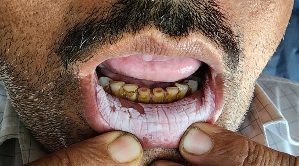 hx of tobacco use History smoking Diagnosis? Hx of chronic tobacco