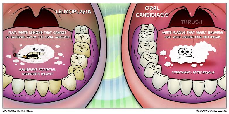 PeterItebimien's tweet photo. @BrownJHM @ArunInamadar Oral Leukoplakia is a thickened white patches or plaques inside the mouth. They are often associated with chewing or heavy smoking of tobacco products. It maybe a premalignant lesion.
DD⤵️
Oral candidiasis
Oral lichen planus
Rx;quit smokeless tobacco chewing,stop smoking tobacco https://t.co/TFTvDd9LZt