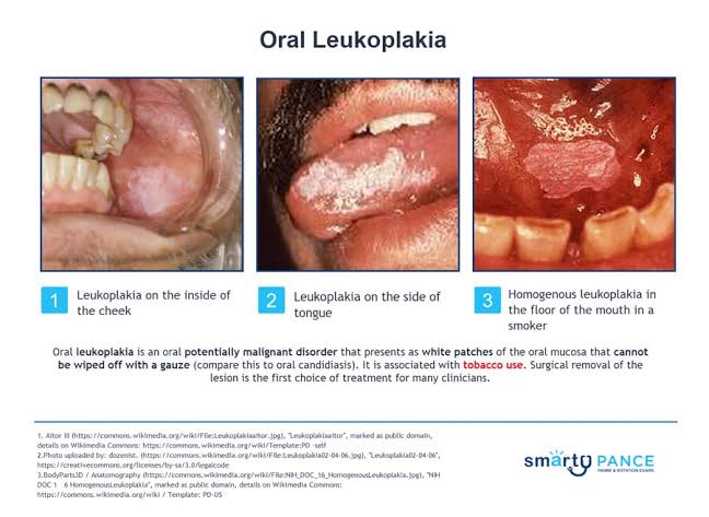 Itebimien Peter on X: @BrownJHM @ArunInamadar Oral Leukoplakia is a  thickened white patches or plaques inside the mouth. They are often  associated with chewing or heavy smoking of tobacco products. It maybe