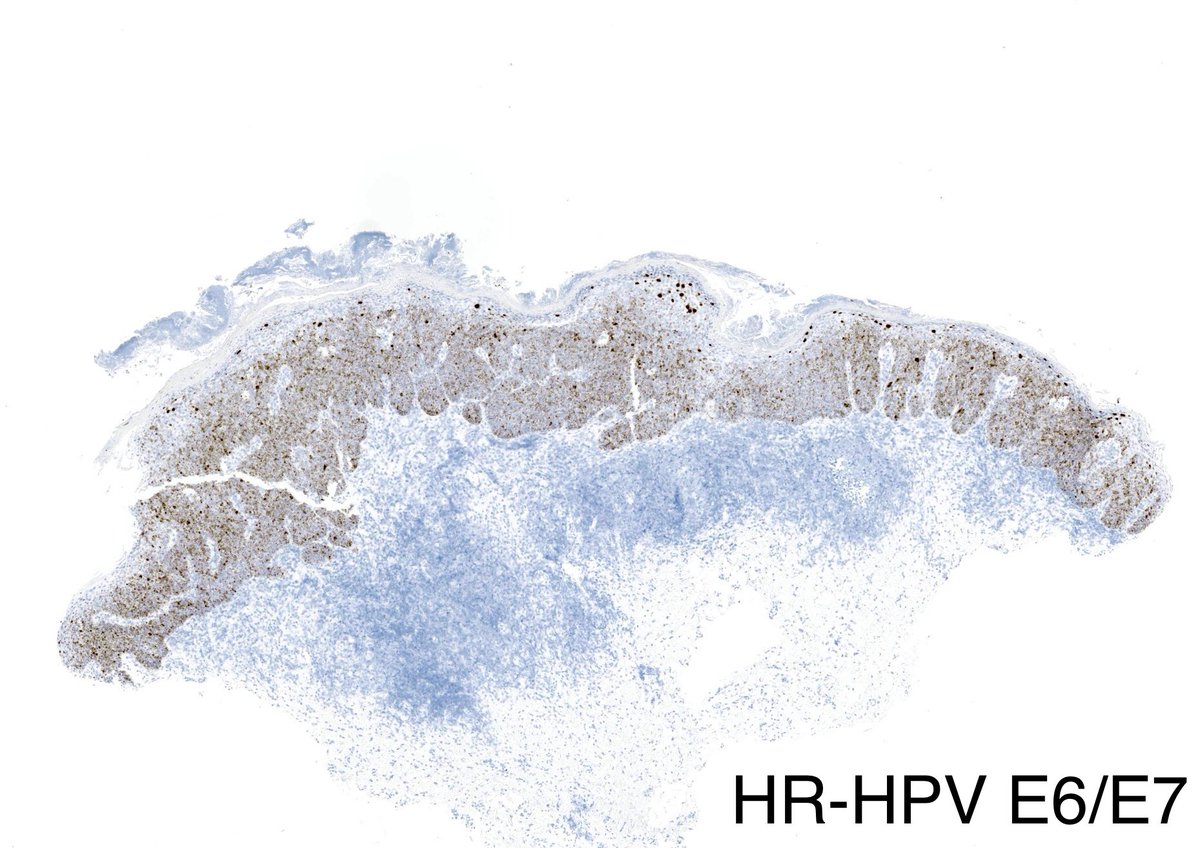 Oral cavity lesion. 

#pathology #pathologist #headandneck #PathTwitter #oralpath #ENT #ENT_Pathology #headandneckpathology