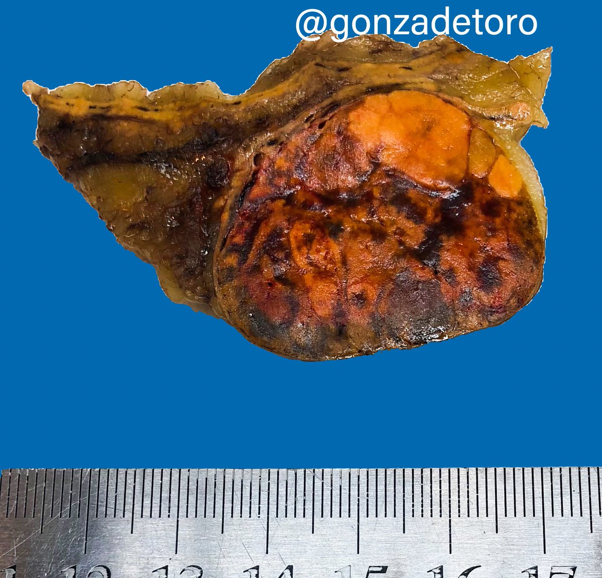 gonzadetoro's tweet image. 58yo male, Adrenal mass. Grossnosys4residents #pathology #grosspath #Pathresidents @mreyesm @Histopatolomon @Maryross86 @angelpanizo1 @Williamson_SR @Kiril_T_Can @ariella8 @DrBMcGinn @evacomperat @MoAhmedMD @DrJPLow @thejourneymate @HENRYY_MD @TristanRutland7